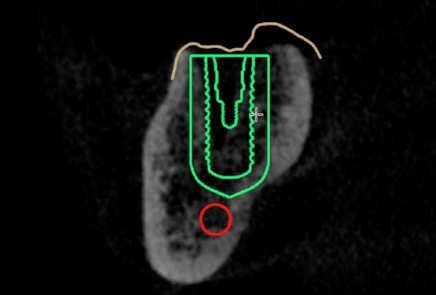 Creation of 3D printed surgical guide showing 1.5 mm buffer zone between implant and nerve in red.