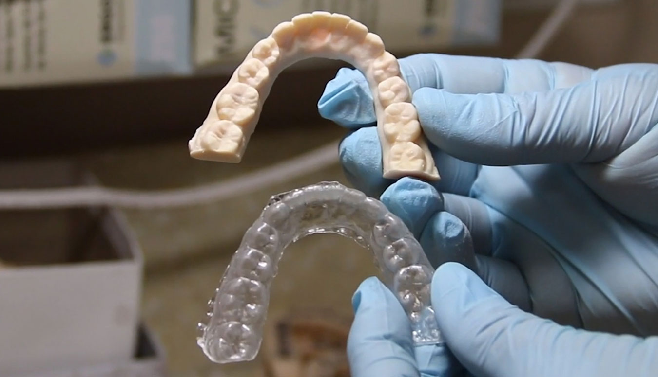 Orthodontic Aligners