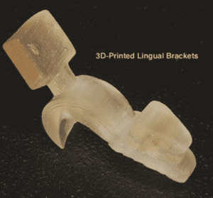 3D printed lingual brackets