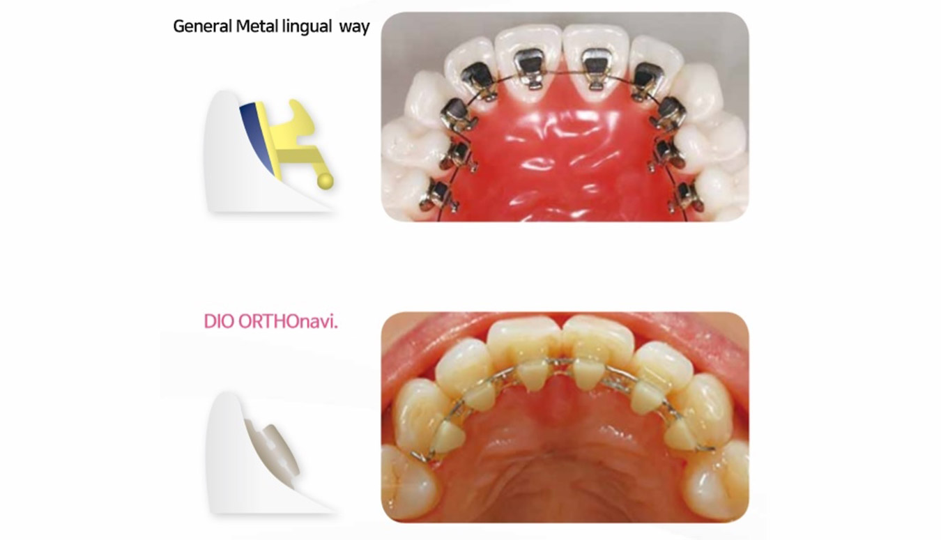 lingual brackets fitted