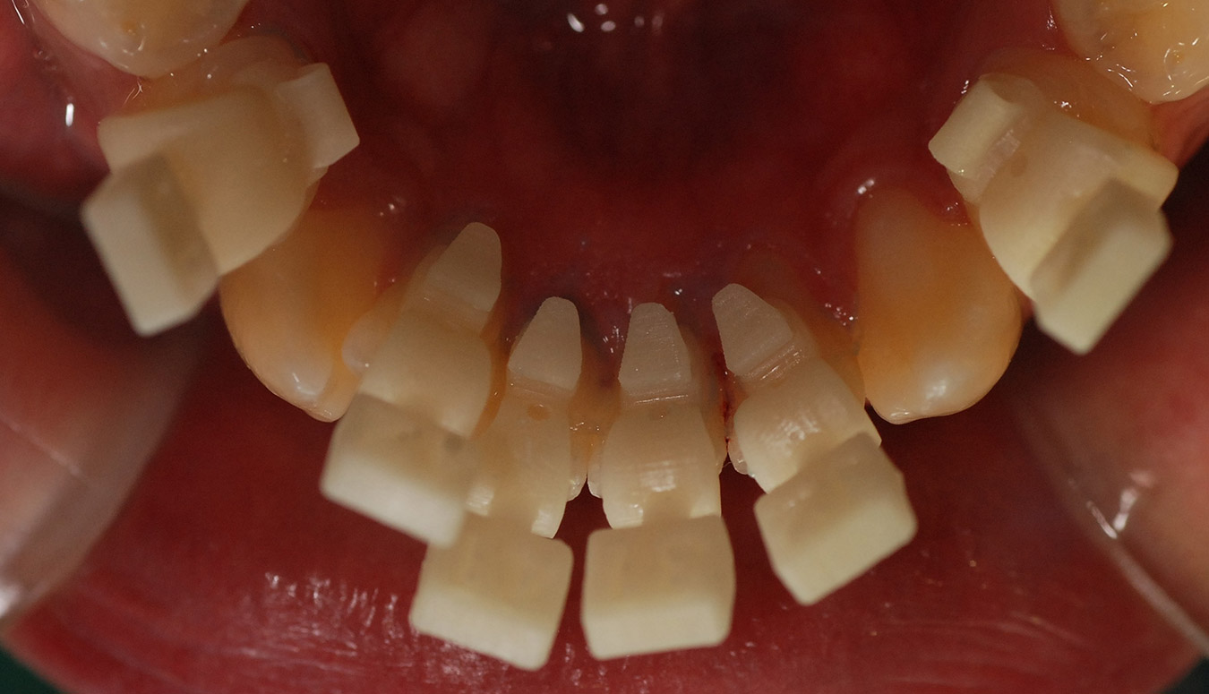 3D printed lingual brackets on teeth